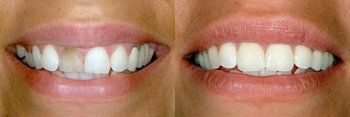 Before & After Bonding - Martinsville Dentist