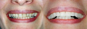 Before & After Crowns - Dentist Martinsville, VA