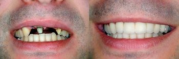 Before & After Dental Implants Martinsville